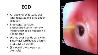 Case discussion Esophageal stricture [upl. by Victoir590]