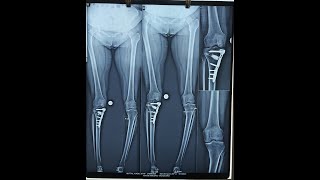 HTO HIGH TIBIAL OSTEOTOMY [upl. by Lazes]