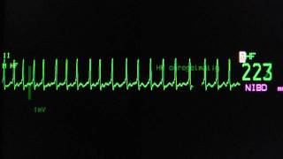 atrial fibrillation with rapid ventricular rate on an ECG heart monitor [upl. by Artima]