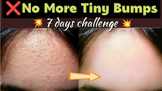 💥Get rid of tiny bumps in 7 days challenge 100 resultsGet amazing even skin tone 100 [upl. by Anatnas]