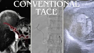 Managing Advanced Hepatocellular Carcinoma in an Elderly Patient A Case Study [upl. by Arte255]