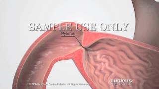 Pyloric Stenosis Blocked Stomach [upl. by Folberth]