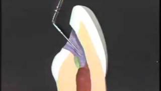 Endodontic Cavity Preparation [upl. by Marutani]