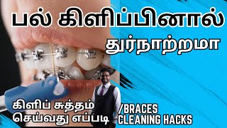 பல் கிளிப் அணிந்தவர்கள் கண்டிப்பாக செய்ய வேண்டியவை𝐇𝐨𝐰 𝐭𝐨 𝐜𝐥𝐞𝐚𝐧 𝐛𝐫𝐚𝐜𝐞𝐬 𝐢𝐧 𝐭𝐚𝐦𝐢𝐥 [upl. by Assirehc678]