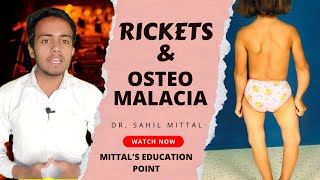 Rickets and Osteomalacia Lecture in Hindi By Dr Sahil Mittal [upl. by Juetta]