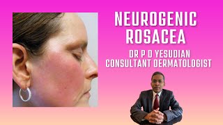 Neurogenic rosacea [upl. by Finbar36]