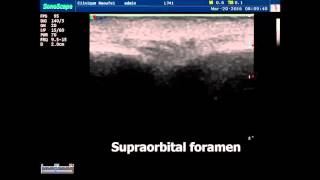 Ultrasound guided supraorbital nerve block Face block [upl. by Nino285]