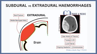 ncct brain subdural hemorrhagetraumatic subdural haemorrhage Dr Subodh SKP [upl. by Labanna]