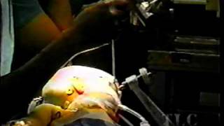 Hemispherectomy  Understanding the Amazing Brain  The Learning Channel  1999 [upl. by Akcirderf754]