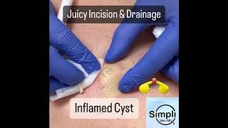 Inflamed Cyst Incision amp Drainage [upl. by Kurtzig549]