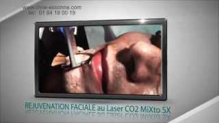 REJUVENATION FACIALE au Laser CO2 Micro Fractionné MiXto SX  CLME Montlhéry Essonne [upl. by Yetty]