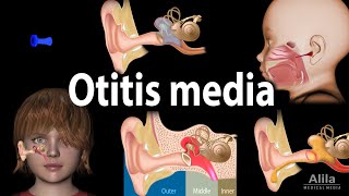 Otitis Media Anatomy Pathophysiology Risk Factors Types of OM Symptoms and Treatment Animation [upl. by Nylarat543]