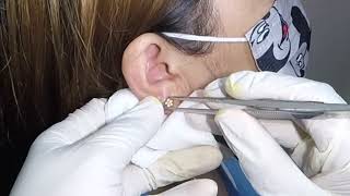 How to Remove an Earring Stuck in Womans Earlobe [upl. by Nawuq751]