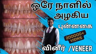 3 நாட்களில் நிரந்தர பல் சீரமைப்புடெண்டல் வினீர் 𝐃𝐞𝐧𝐭𝐚𝐥 𝐕𝐞𝐧𝐞𝐞𝐫 𝐢𝐧 𝐓𝐚𝐦𝐢𝐥 𝐈𝐦𝐦𝐞𝐝𝐢𝐚𝐭𝐞 𝐬𝐦𝐢𝐥𝐞 𝐦𝐚𝐤𝐞𝐨𝐯𝐞𝐫 [upl. by Markowitz]