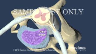 Cervical Disc Herniation [upl. by Kenlee899]