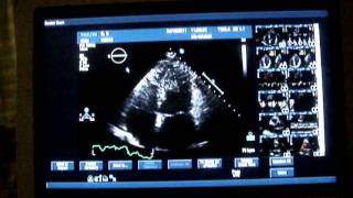 Ultrasound scan of my heart [upl. by Nwahsel]