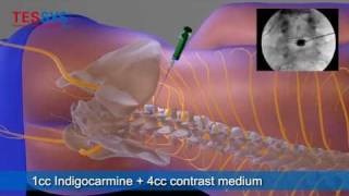 Treatment of herniated disc with TESSYS method lateral  BandscheibenOP mit TESSYSMethode lateral [upl. by Rhodia]