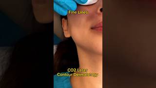 CO2 Laser Changed My Skin😱 acne acnescars beauty [upl. by Henricks]