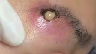 Big Cystic Acne Blackheads Extraction Blackheads amp Milia Whiteheads Removal Pimple Popping 099 [upl. by Faludi]