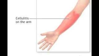 What Is Cellulitis [upl. by Elpmid]