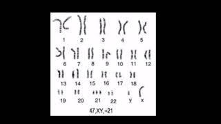 Down syndrome karyotype analysis third copy of chromosome 21 MR non dysjunction 95  of cases [upl. by Cookie]