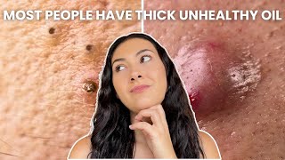 How To Treat Every Type of Acne Comedones Nodules Cysts [upl. by Almira]