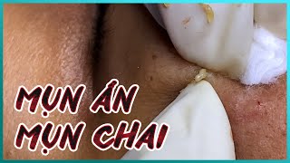 Big Cystic Acne Blackheads Extraction Blackheads amp Milia Whiteheads Removal Pimple Popping [upl. by Haya]