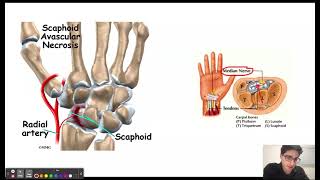 USMLE Step 1 Question of the Day 22 Outstretched Hand Fall [upl. by Enirol390]