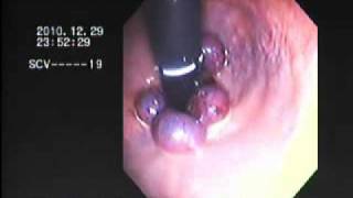 haemorrhoid banding BY DR NASEEM GHOURI [upl. by Gallard]