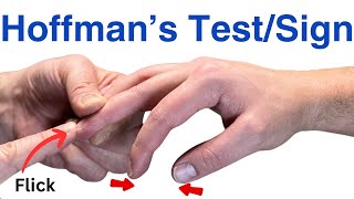 How to Perform a Hoffmans Test  Inverted Supinator Sign  Clonus  Hyperreflexia [upl. by Plumbo]