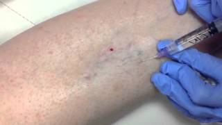 Sclerotherapy [upl. by Lynett]