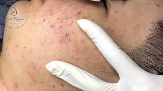 Loan Nguyen Acne Treatment 00036 [upl. by Otina]