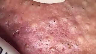 Blackheads amp Whiteheads Satisfying Removal 0275 [upl. by Adniled]