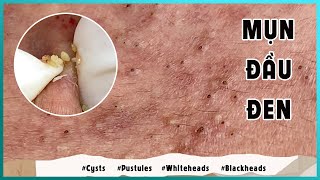 Big Cystic Acne Blackheads Extraction Blackheads amp Milia Whiteheads Removal Pimple Popping [upl. by Dougal]