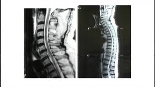 Post traumatic c7 t1 spondylolisthesis surgical treatment  Dr Massimo Balsano [upl. by Yor656]