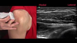 Ultrasound of the Shoulder [upl. by Alten815]