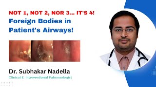 Removal of Betel Nut from Lungs Bronchoscopy Procedure  Dr Subhakar Nadella \ KIMS [upl. by Eybba]