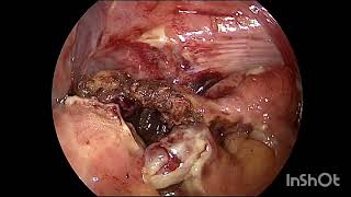 laparoscopic appendectomy in a 36 years old male with Gangrenous Appendix [upl. by Blas]