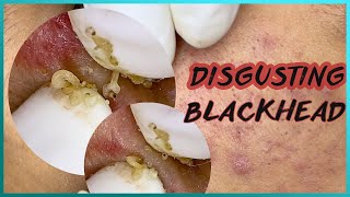 Big Cystic Acne Blackheads Extraction Blackheads amp Milia Whiteheads Removal Pimple Popping [upl. by Schnorr]