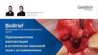 Одномоментная имплантация в эстетически значимой зоне с осложнениями [upl. by Yer]