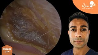 1219  Hardened Ear Wax Wrapped in Dead Moist Skin Removal [upl. by Calista]