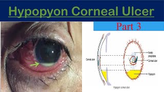 Hypopyon Corneal Ulcer keratitis part 3 [upl. by Jeavons]