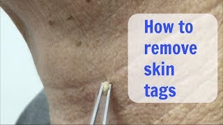 Painless Cryo Skin Tags removal  Cosmetic Institute of Australia [upl. by Timmi460]