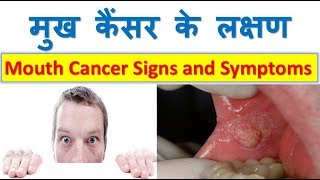 Mouth Cancer symptoms in Hindi [upl. by Ielarol]