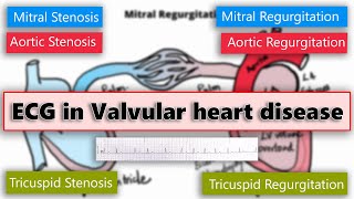 ECG changes in Valvular heart disease [upl. by Byrann]