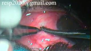 Conjunctival Graft Suturing For Pterygium Excision With Autograft By Dr Sudhir Singh 33 [upl. by Nylasor]