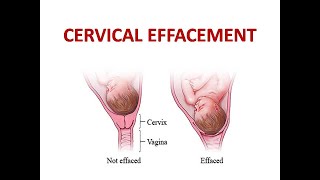 CERVICAL EFFACEMENT [upl. by Atirres]