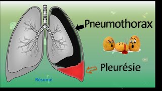 💨 Pneumothorax 🆚 Pleurésie 💧  Résumé  PneumoPhtisiologie [upl. by Elime]