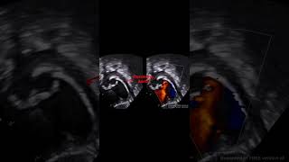 Modified Subcostal Echo View echocardiography pediatriccardiology echocardiogram [upl. by Hyman]