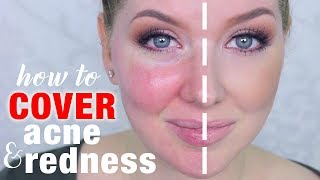 How to Cover Acne amp Redness  DRUGSTORE Makeup [upl. by Gale]